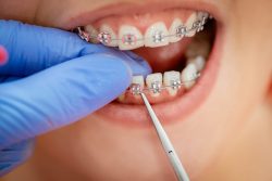 Braces power chain colors /\Smile! The Colorful World of Power Chains & Braces