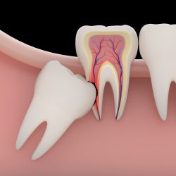 Wisdom Teeth Removal Houston TX | Wisdom Teeth Extraction Near Me