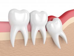 Affordable Wisdom Teeth Removal Houston, TX | Best Dental