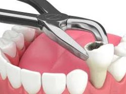 Wisdom Tooth Extraction Near Me – Dentist in Houston, TX