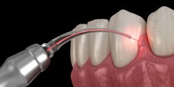 LANAP Laser Dentistry Near Me |LANAP Laser Dentistry Near Me