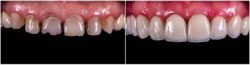 Same-Day Dental Crowns in Houston TX |Same Day Crowns – Houston Dentists