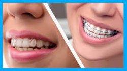 What Do Invisalign Braces Cost?