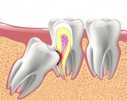 Best low cost wisdom teeth procedure near me in Houston