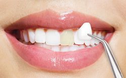 Traditional Veneers in Houston | Best Dentistry Near Me-Dentist Houston