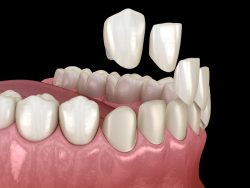 Traditional Veneers Near me | Dental Veneers: Porcelain Veneer Uses