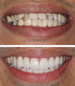 What Are The Different Types of Veneers? | Types Of Veneer Sheet