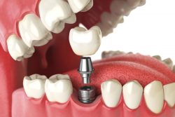 Dental Implants Dentist Near ME