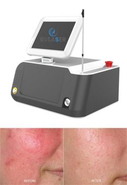 980nm diode laser