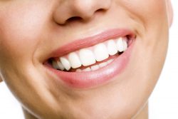 Traditional Veneers in Houston | Houston Pediatric Dentist – Infant Dental Care