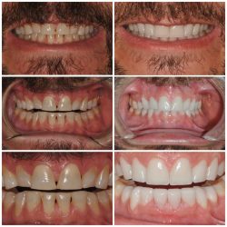 Dentistry Cosmetic Near Me | Cosmetic Dentistry: Before-and-After Pictures – WebMD