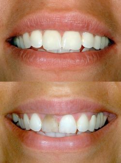 Veneers Dentist Near Me | Dental Veneers Cost In India | Porcelain Veneers Near Me