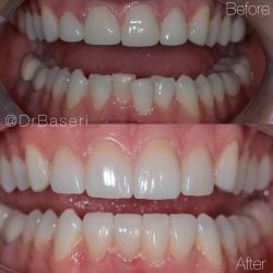 Veneers Gap Teeth