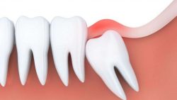 Wisdom tooth extraction – Impacted Wisdom Teeth Removal Near Me | Emergency Wisdom Tooth R ...