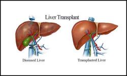 Acute Liver Failure