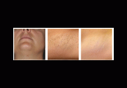 Hair removal Killeen