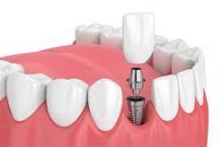 Dental Implant Cost