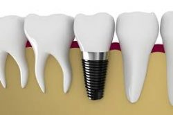 Dental Implant in India