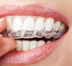 Invisalign San Diego CA – Gentle Dentistry