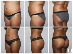 Brazilian Butt Lift (BBL) Surgery Near Me | Brazilian Butt Lift Procedure