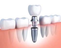 Affordable Dental Implants – Implant Secured Denture