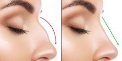 Nose Plastic Surgery Near Me | Rhinoplasty Surgery For Nose | Best Rhinoplasty Surgeon