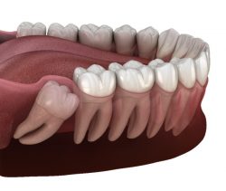 Wisdom tooth removal – Recovery – NHS