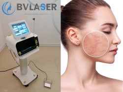 980nm diode laser for vascular removal best laser machine for spider veins