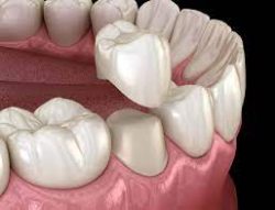 Same-Day Dental Crowns in Houston TX | Dentist in Houston, TX