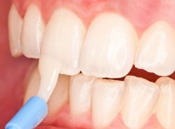 Fluoride Treatment For Teeth |Fluoride treatment: Benefits, side effects