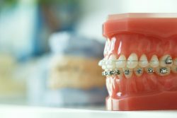 How Do Underbite Braces Work? |How Do Braces Fix Underbites?