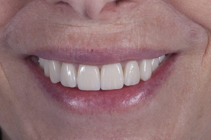 Which Is The Best Dental Crown To Get? | How to Choose the Best Type of Dental Crown for You