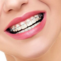 Adult Dental Braces Near Me