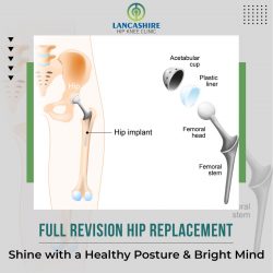 Total Hip Replacement & Arthroplasty Surgery