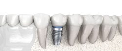 Dental Implant Specialist Near Me | Dental Implants Houston Texas