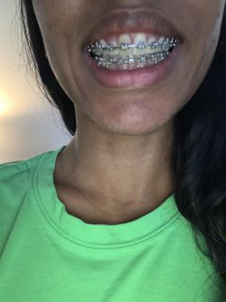Braces power chain colors | Double Power Chain Braces