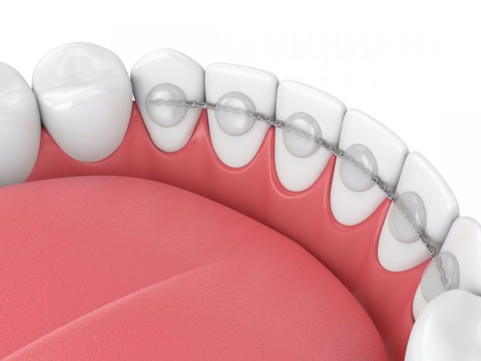 Clear Teeth Aligners In Houston, Tx