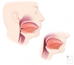 Basics of Central Sleep Apnea| Obstructive Sleep Apnea Causes