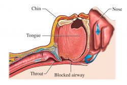 Central Sleep Apnea Treatment | Causes of central sleep apnea