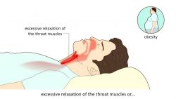 Central Sleep Apnea | Central Sleep Apnea Syndrome