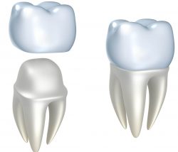 Dental Crown In Houston, Tx | Same Day Crowns Near Me