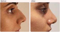 Rhinoplasty Procedure in Delhi