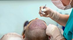 Best Hair transplant doctor in Jaipur