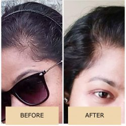 Botox treatment in kolkata