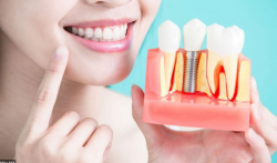 Dental Implants in Richmond