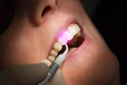 Laser Dentistry