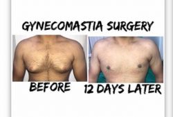 Gynaecomastia, Or Male Breast, Correction: Flat Chest Guaranteed