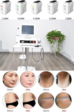 HIFU Ultrasound machine treatment effect