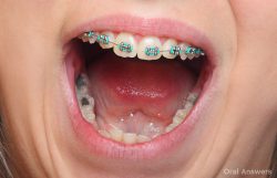 How long do silver amalgam fillings last?