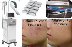 Who is suitable for IPL laser machine treatment